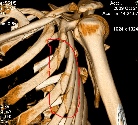 Broken+scapula