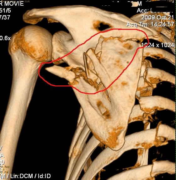 Broken+scapula