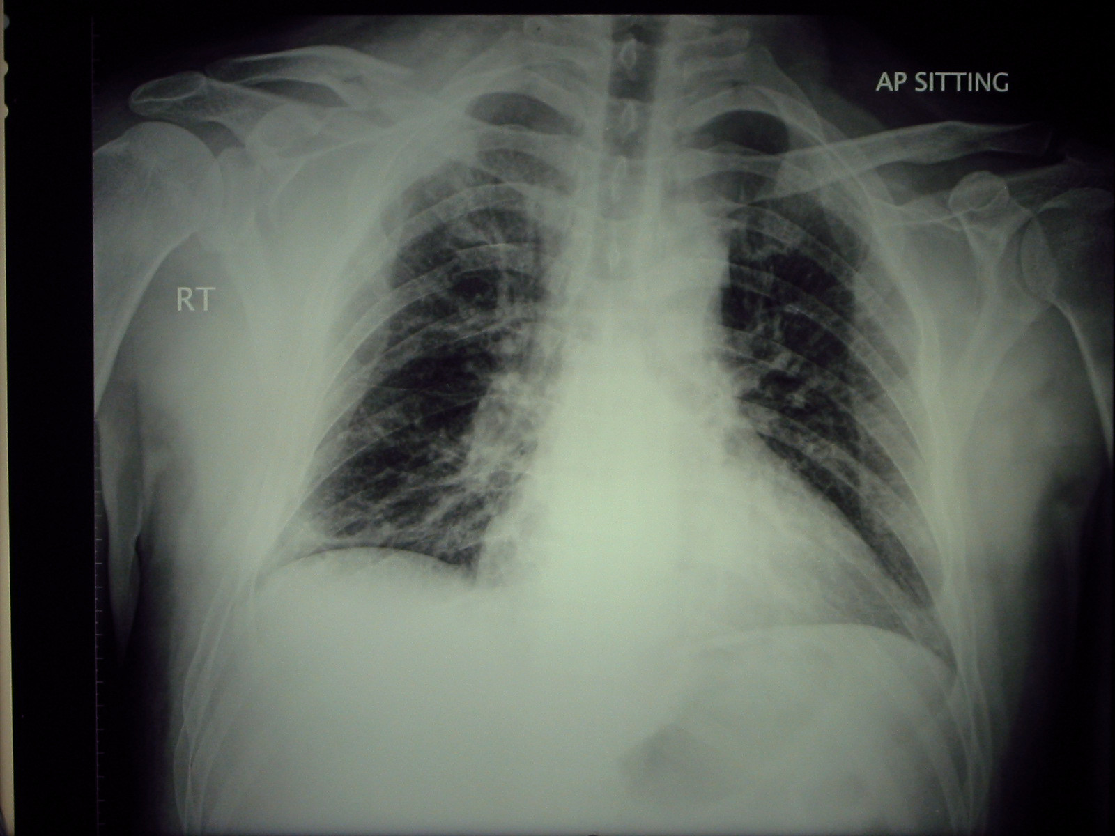 Broken+scapula